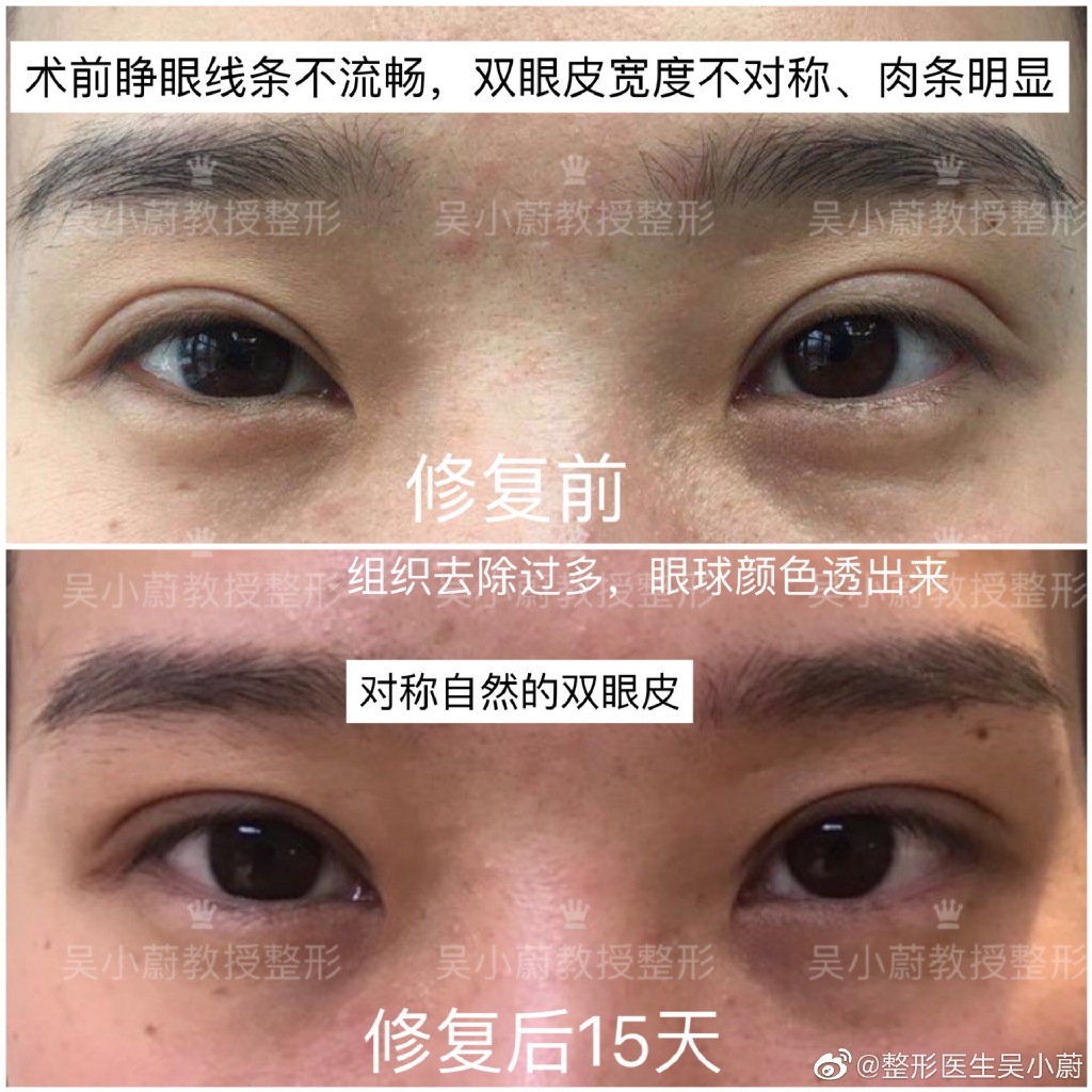 吳小蔚雙眼皮修復(fù)案例