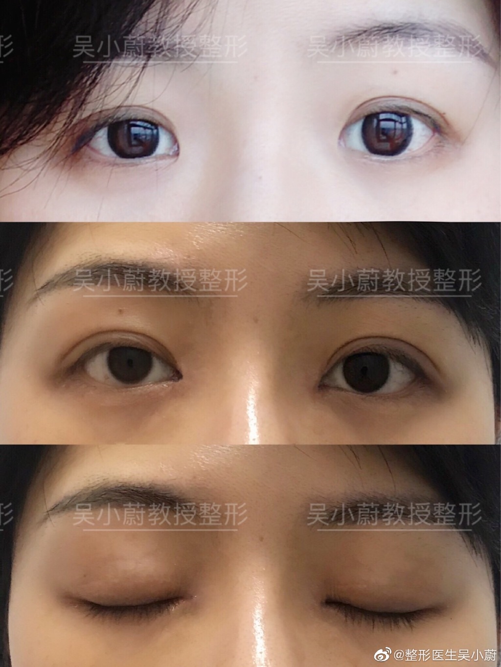 吳小蔚雙眼皮修復(fù)案例