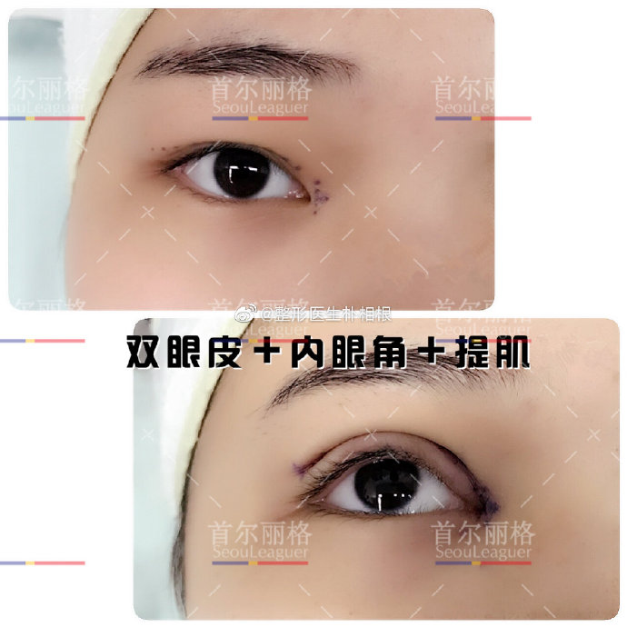 樸相根雙眼皮案例
