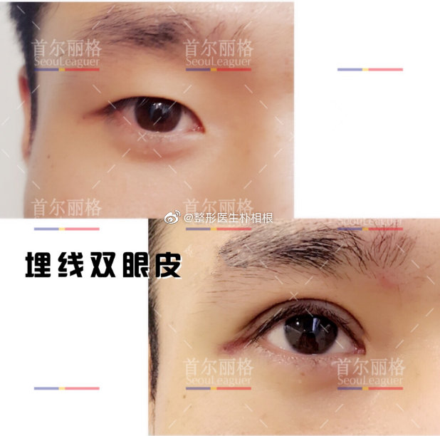 樸相根雙眼皮案例