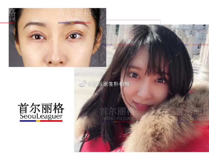 樸相根雙眼皮案例