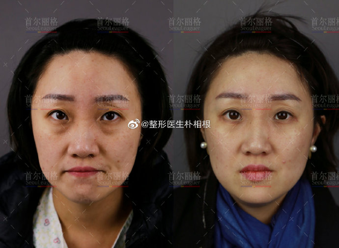 樸相根雙眼皮案例
