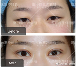 師麗麗眼綜合案例