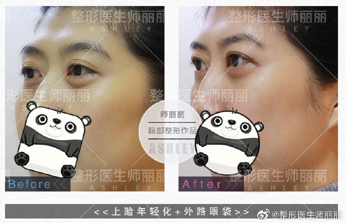師麗麗眼綜合案例