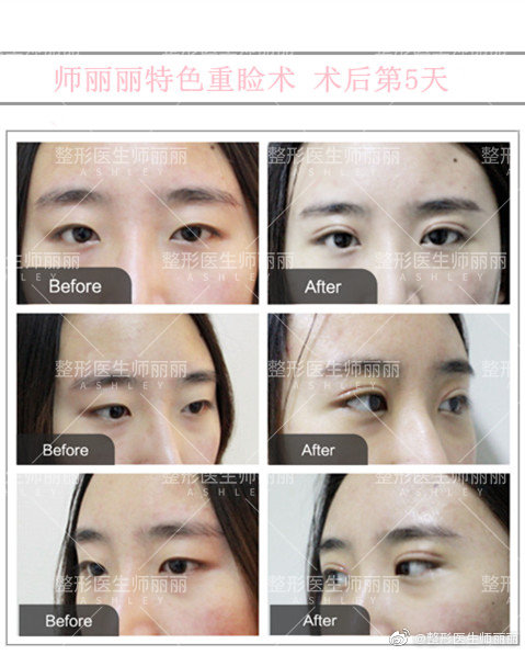 師麗麗眼綜合案例