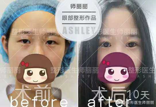師麗麗眼綜合案例