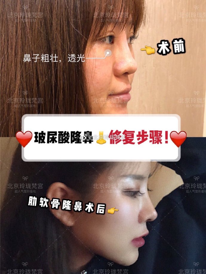 王光輝鼻子案例
