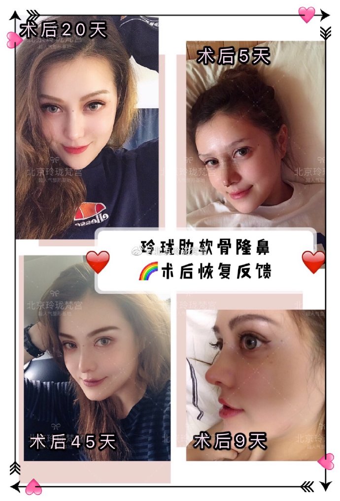 王光輝鼻子案例