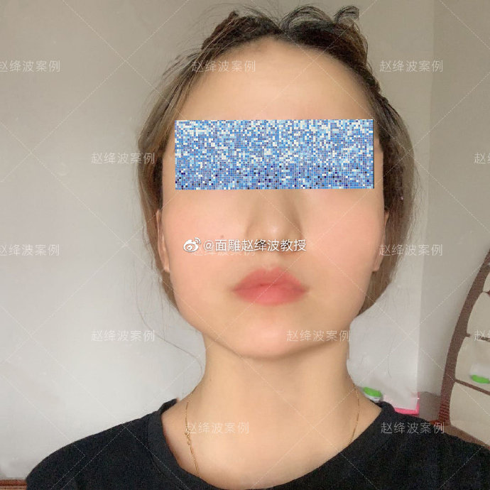 趙絳波改臉型案例