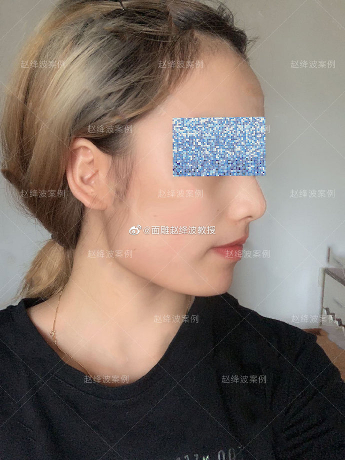 趙絳波改臉型案例