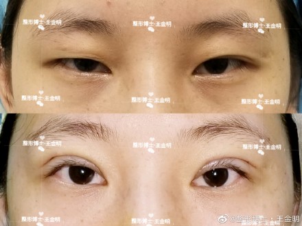 王金明雙眼皮案例