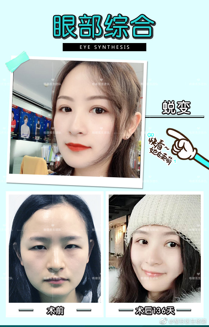 楊璐雙眼皮案例