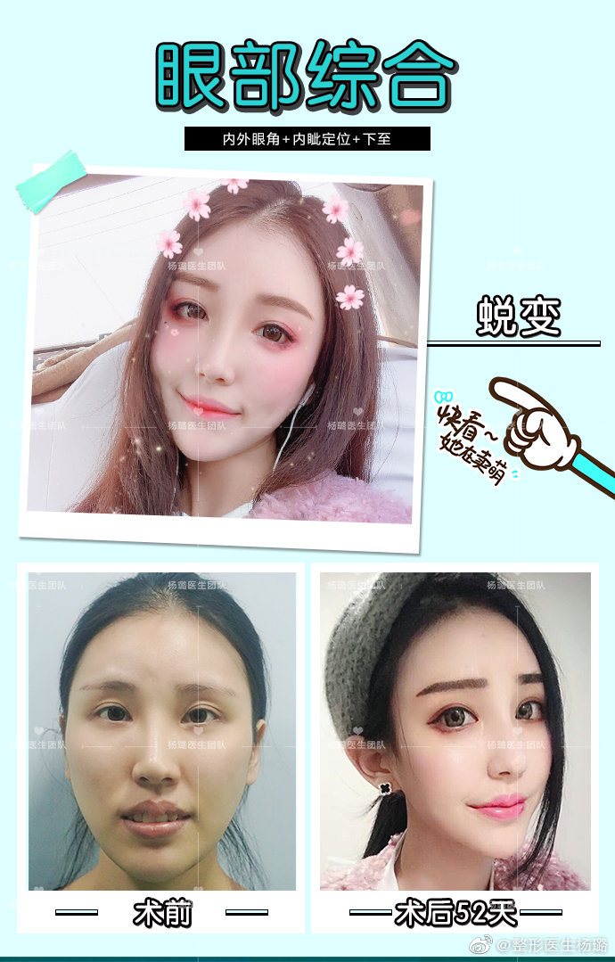 楊璐雙眼皮案例