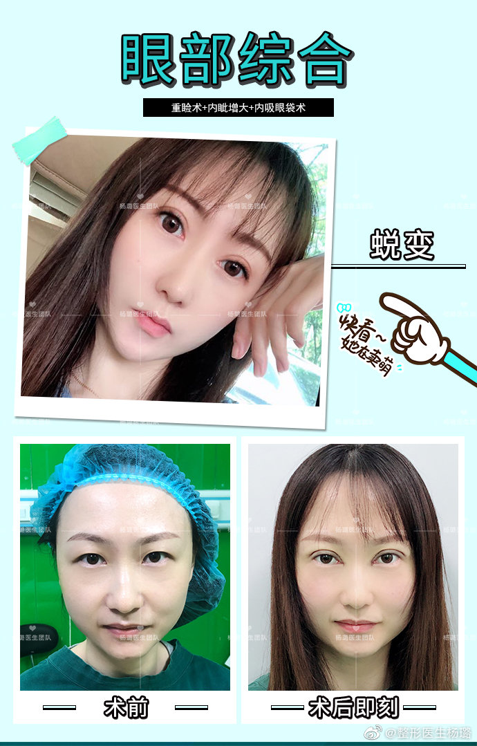 楊璐雙眼皮案例