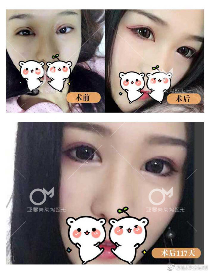張海明雙眼皮修復案例