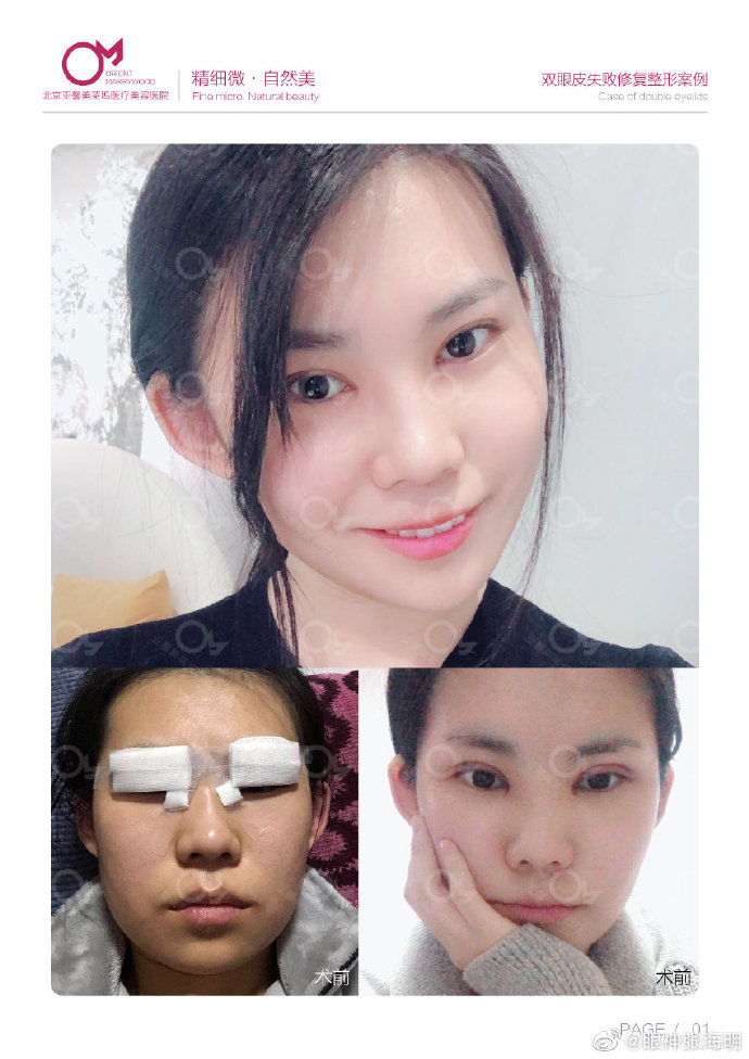 張海明雙眼皮修復案例