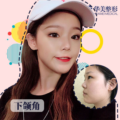 付國友磨骨案例
