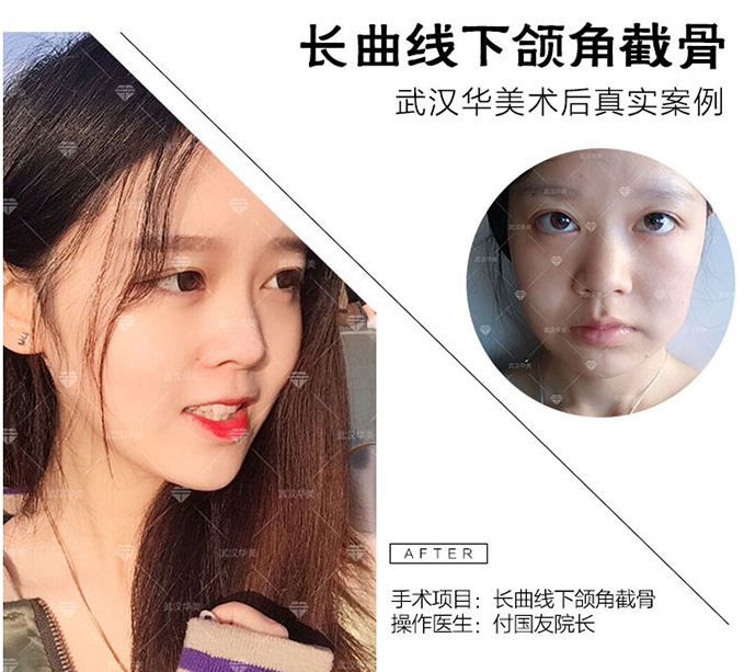 付國友下頜角案例