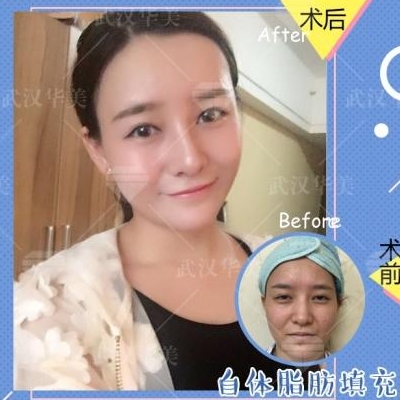 劉光偉面部填充案例
