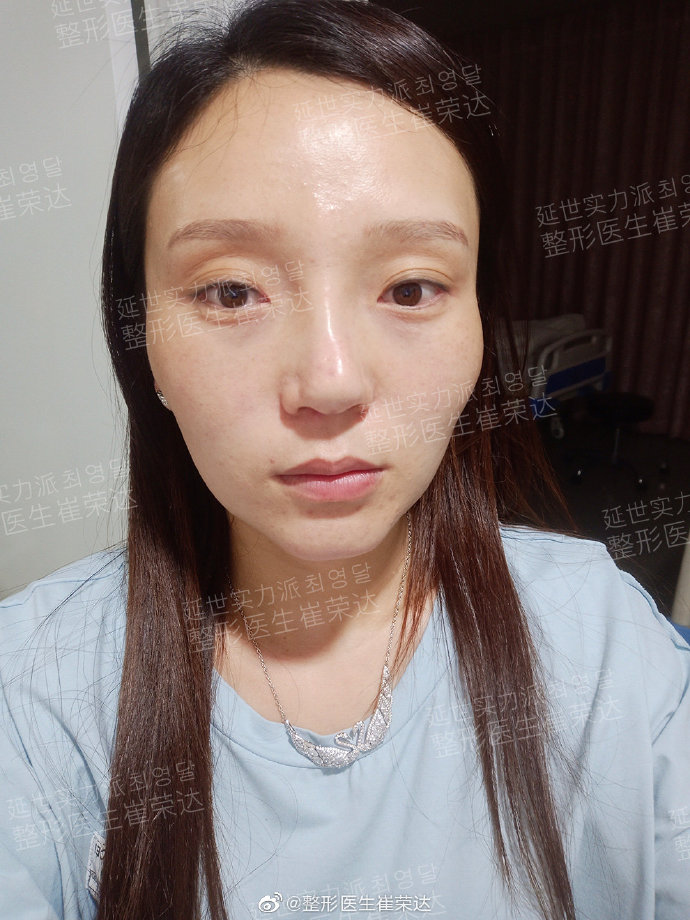 崔榮達下頜角顴骨案例