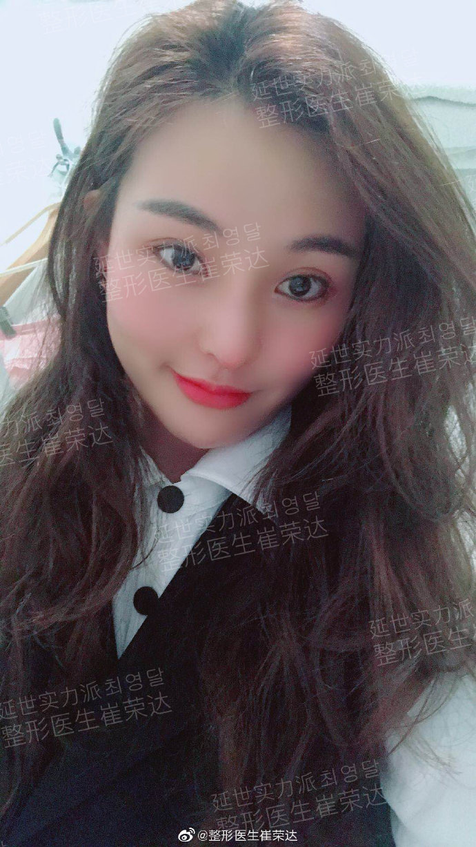 崔榮達面部輪廓案例