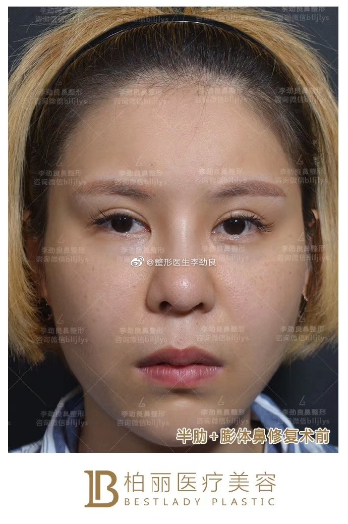 李勁良鼻修復案例
