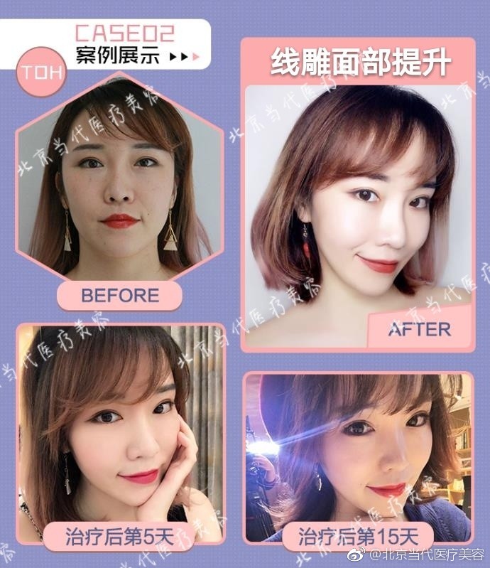 齊永樂面部提升案例