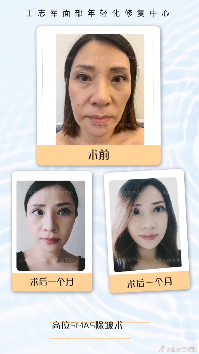 王志軍除皺案例