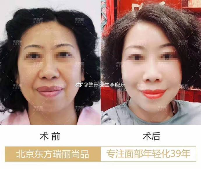 李曉東面部除皺案例