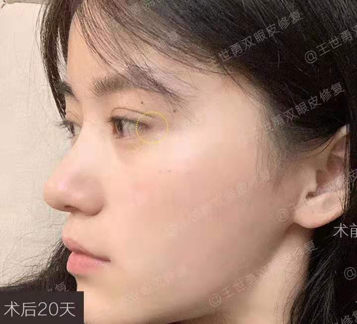 王世勇外眼角修復案例