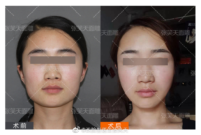 張笑天下頜角整形案例