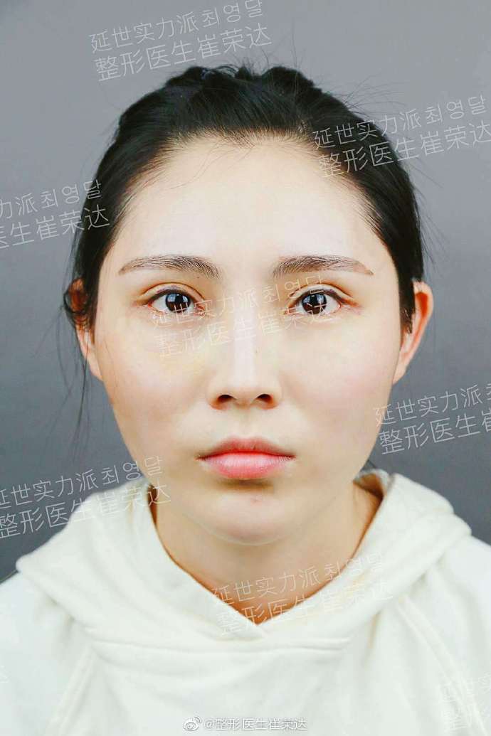 崔榮達(dá)磨骨案例