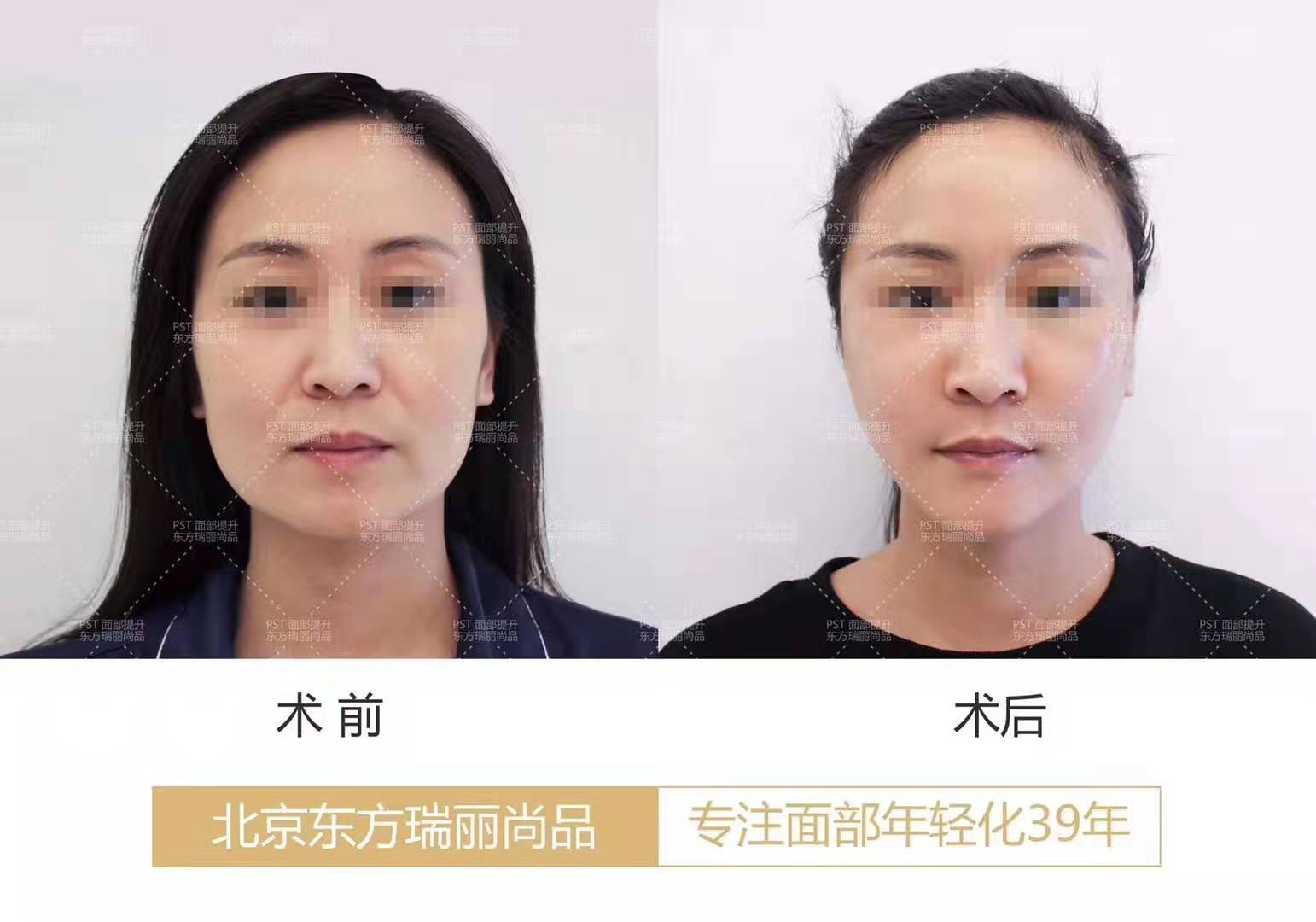 李曉東面部提升案例