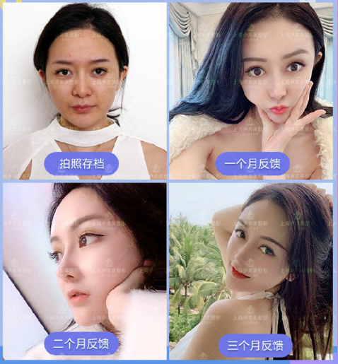 錢玉鑫鼻綜合案例