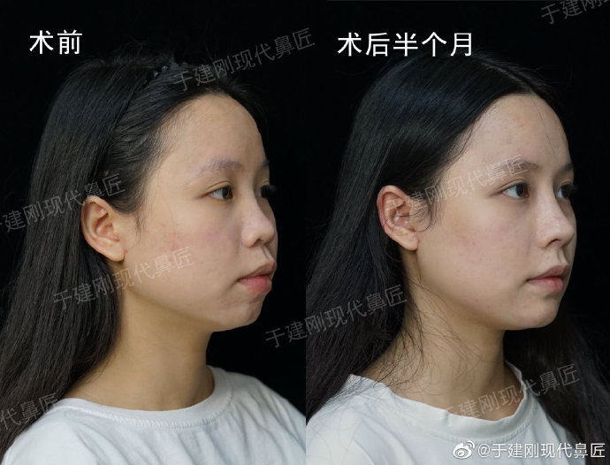 于建剛鼻修復案例