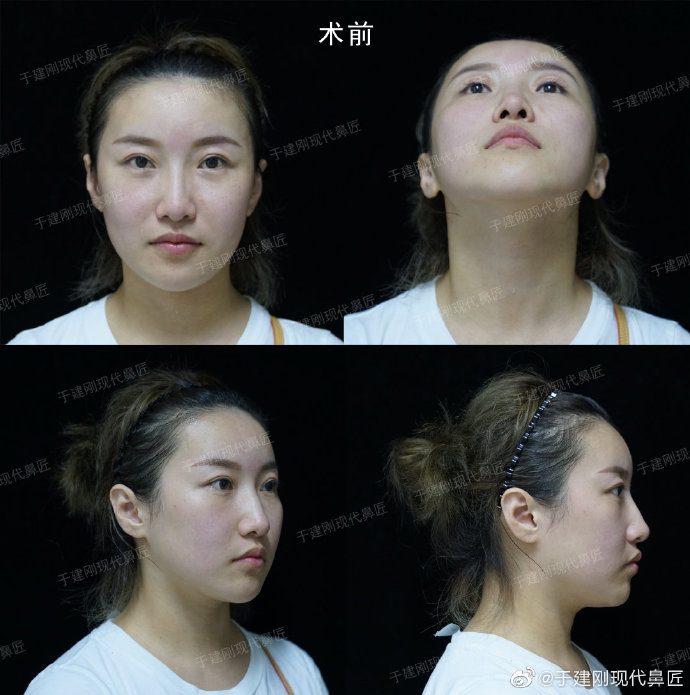 于建剛鼻修復案例