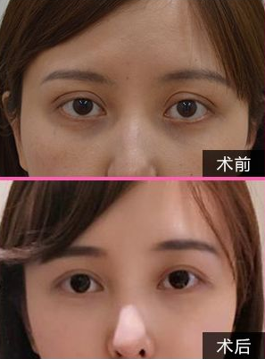劉風卓雙眼皮案例