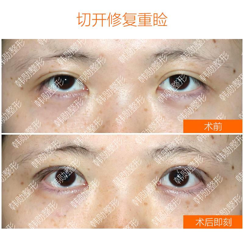 韓勛雙眼皮修復案例