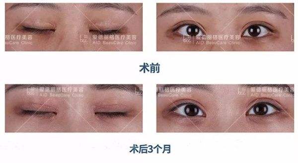 劉志剛雙眼皮修復案例