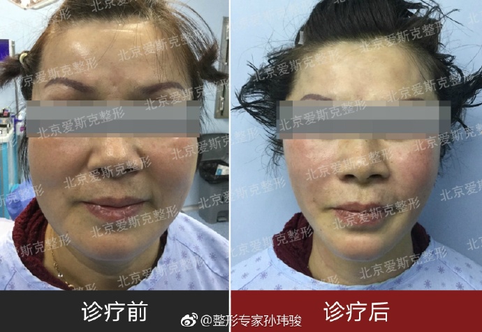 孫瑋駿面部提升專家