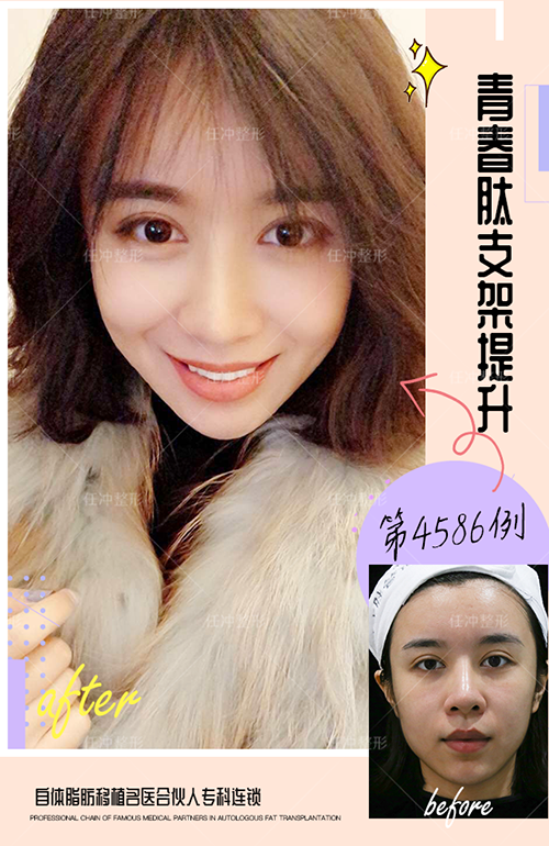任沖面部提升