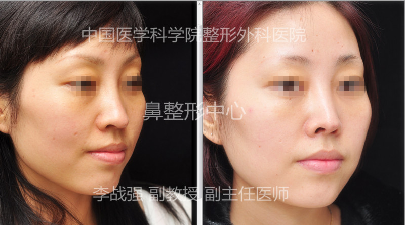 李戰強隆鼻案例