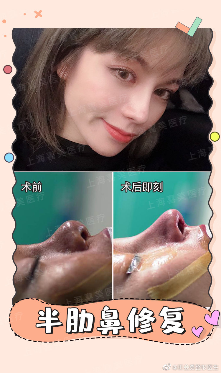 王會(huì)勇鼻修復(fù)案例