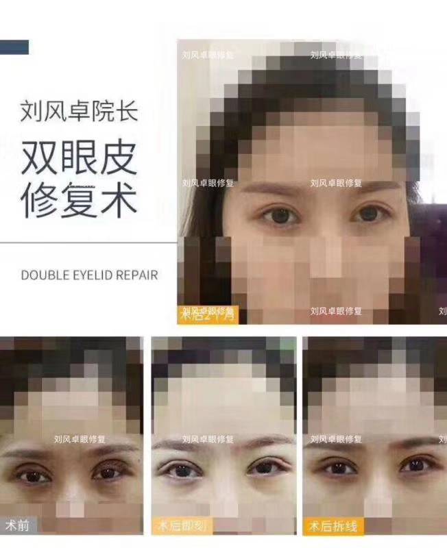 劉風(fēng)卓案例