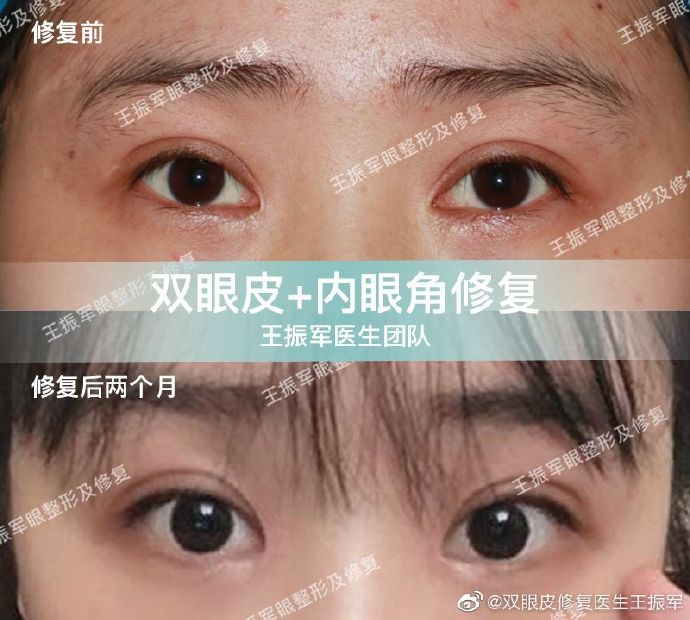 王振軍雙眼皮修復(fù)案例