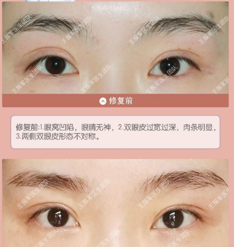 王振軍雙眼皮修復(fù)案例