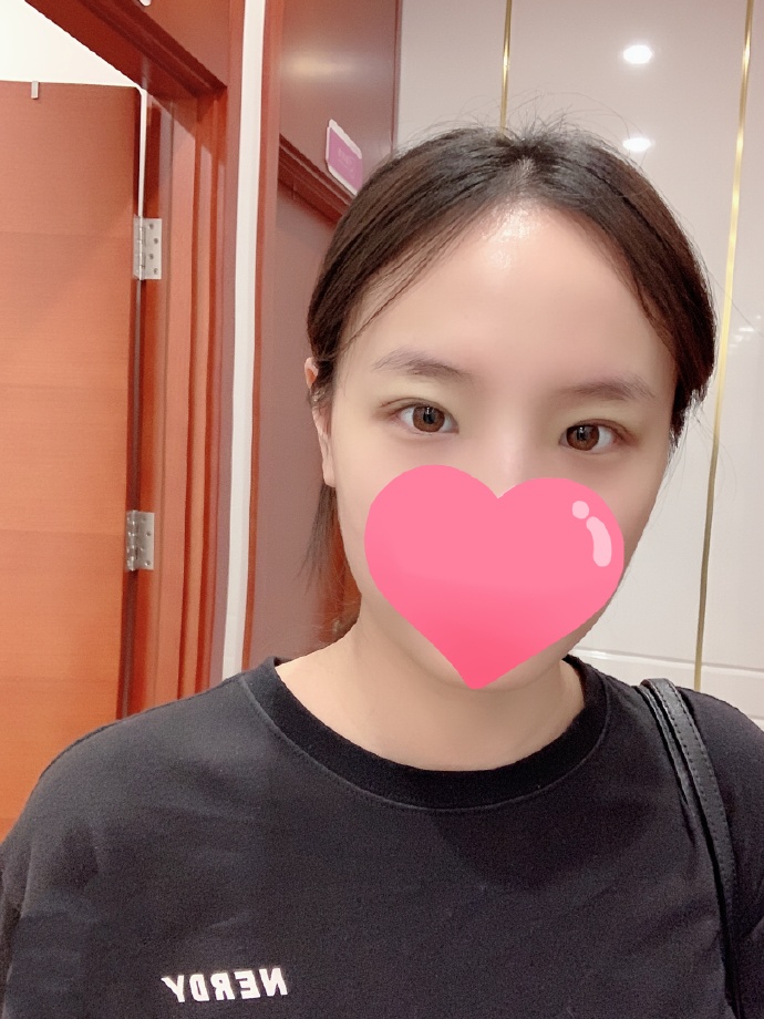 靳小雷、王世勇和韓勛哪個(gè)雙眼皮修復(fù)好？
