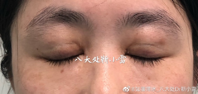 靳小雷雙眼皮修復案例