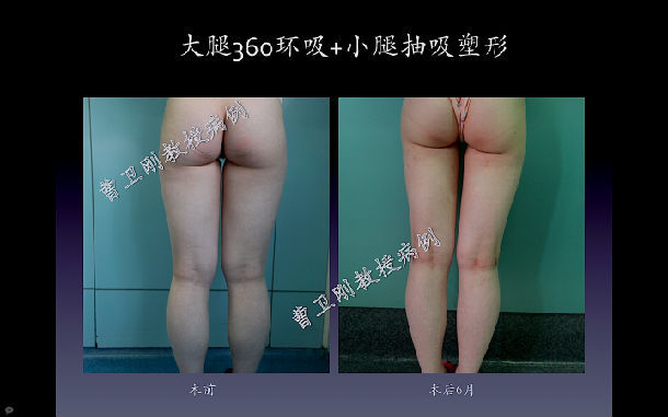 曹衛剛大腿環吸案例