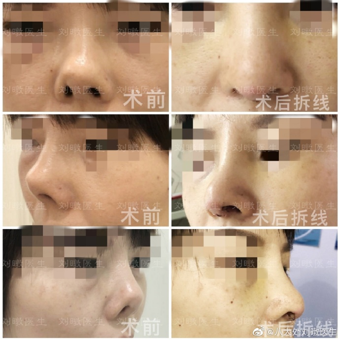 劉暾鼻修復(fù)案例